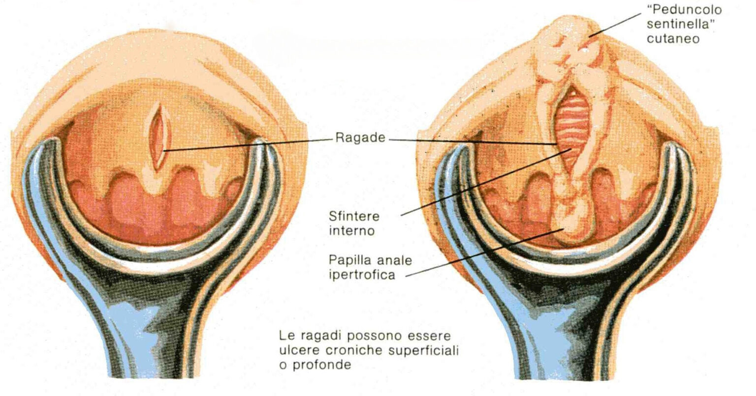 Ragade Anale Cos E Come Si Cura Dossiersalute