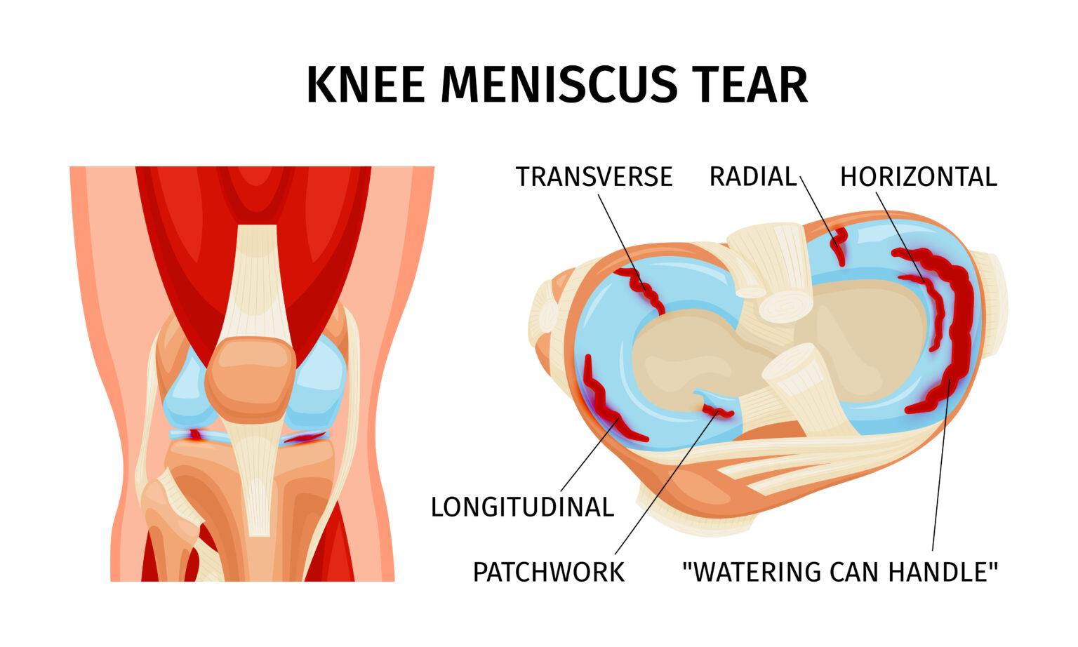 Sutura Meniscale Per Quali Lesioni Una Soluzione Valida